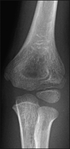 Fracture_Lateral condyle_Figure 2_1101127-Lateral_Condyle_AP.jpg